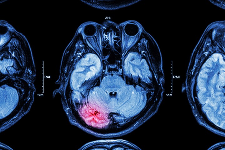 A brain injury from an accident can leave you unable to work